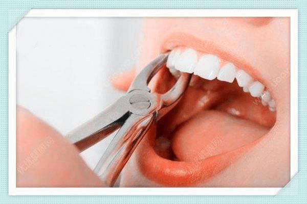 拔牙、洗牙、补牙、种牙、正畸后注意事项